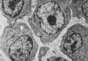 F,72y. | blood - lymphoplasmocellular leukemia F,72y. | blood - lymphoplasmocellular leukemia